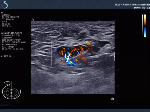 AIXPLORER ULTIMATE BREAST 1 AIXPLORER