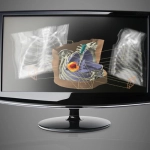 ECLIPSE™- Σύστημα Σχεδιασμού Θεραπείας