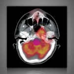 ECLIPSE™- Σύστημα Σχεδιασμού Θεραπείας