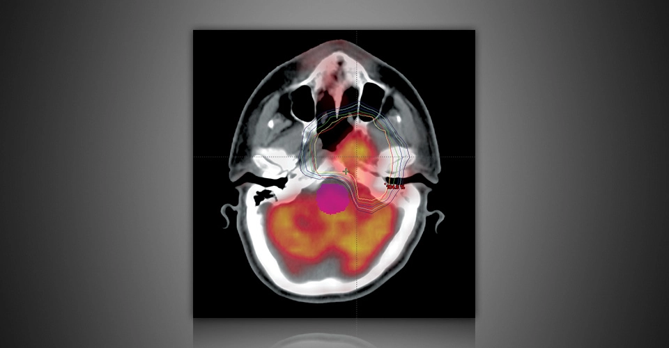 ECLIPSE™- Σύστημα Σχεδιασμού Θεραπείας