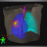 ECLIPSE™- Σύστημα Σχεδιασμού Θεραπείας