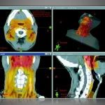 ECLIPSE™- Σύστημα Σχεδιασμού Θεραπείας