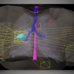 ECLIPSE™- Σύστημα Σχεδιασμού Θεραπείας