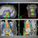 ECLIPSE™- Σύστημα Σχεδιασμού Θεραπείας