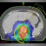 ECLIPSE™- Σύστημα Σχεδιασμού Θεραπείας