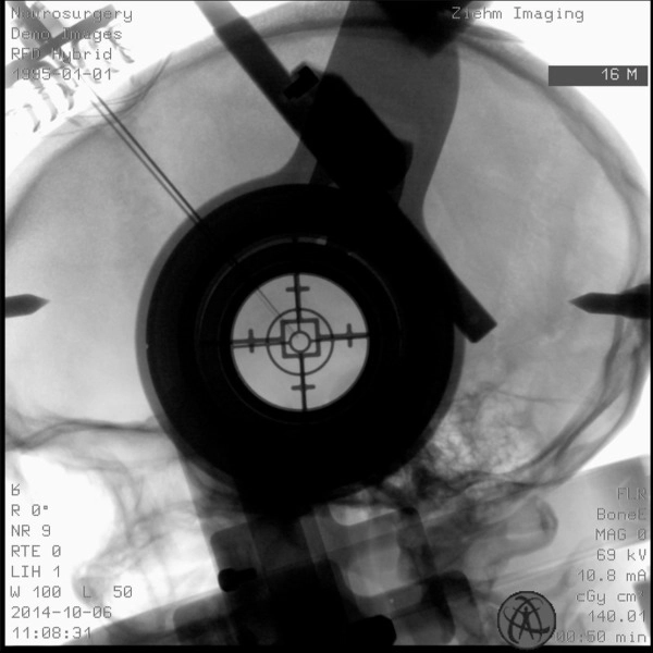 ZIEHM VISION RFD HYBRID EDITION