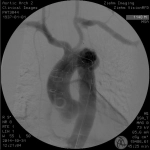 ZIEHM VISION RFD HYBRID EDITION