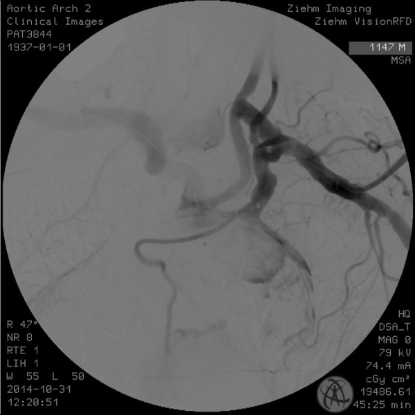 ZIEHM VISION RFD HYBRID EDITION
