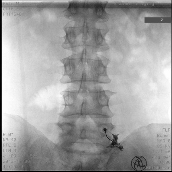 ZIEHM VISION RFD HYBRID EDITION