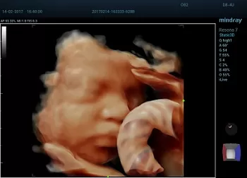 D8-4U_Fetal Face_3D_5-RESONA 7 RESONA