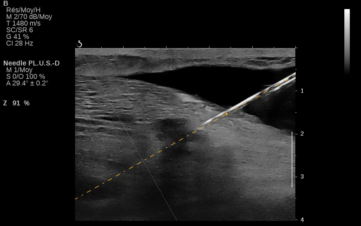 AIXPLORER ULTIMATE BREAST NEEDLE PLUS ΕΛΑΣΤΟΓΡΑΦΙΑ
