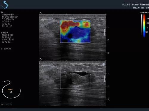 AIXPLORER ULTIMATE BREAST ΕΛΑΣΤΟΓΡΑΦΙΑ