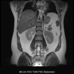 uMR OMEGA™ | 75-cm Ultra-Wide-Bore 3.0T