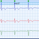 MEDILOG®AR & DARWIN 2, Holter Ρυθμού