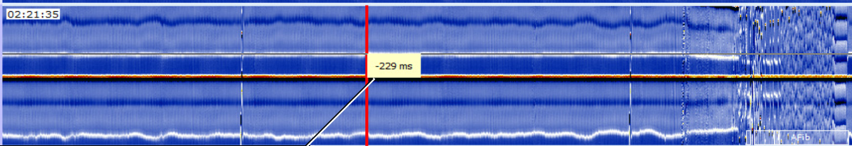 MEDILOG®AR & DARWIN 2, Holter Ρυθμού