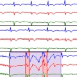 MEDILOG®AR & DARWIN 2, Holter Ρυθμού