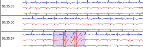 MEDILOG®AR & DARWIN 2, Holter Ρυθμού
