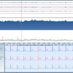 MEDILOG®AR & DARWIN 2, Holter Ρυθμού