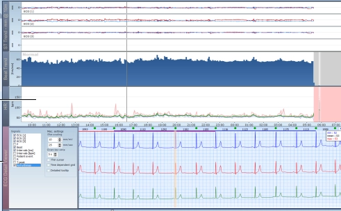 MEDILOG®AR & DARWIN 2, Holter Ρυθμού
