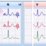 MEDILOG®AR & DARWIN 2, Holter Ρυθμού