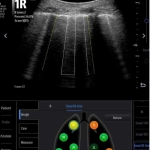 Φορητός Υπέρηχος Mindray ΜΕ7