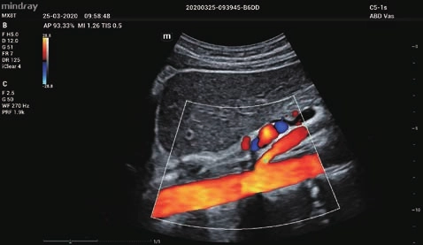 Φορητός Υπέρηχος Mindray ΜΕ7