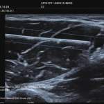 Φορητός Υπέρηχος Mindray ΜΕ7