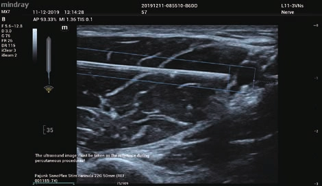 Φορητός Υπέρηχος Mindray ΜΕ7