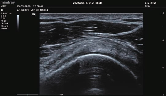 Φορητός Υπέρηχος Mindray ΜΕ7