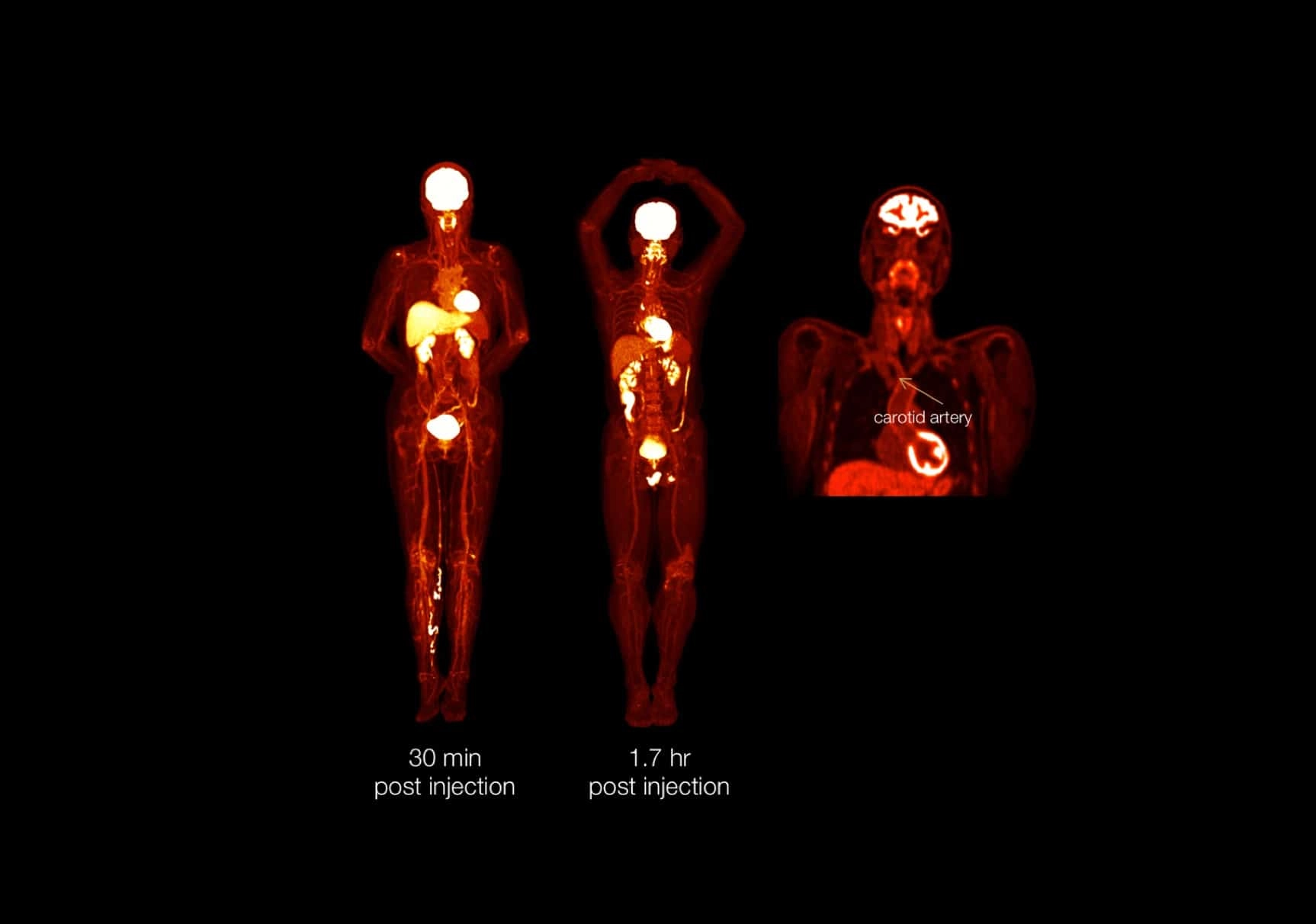 uEXPLORER | Total-body PET/CT