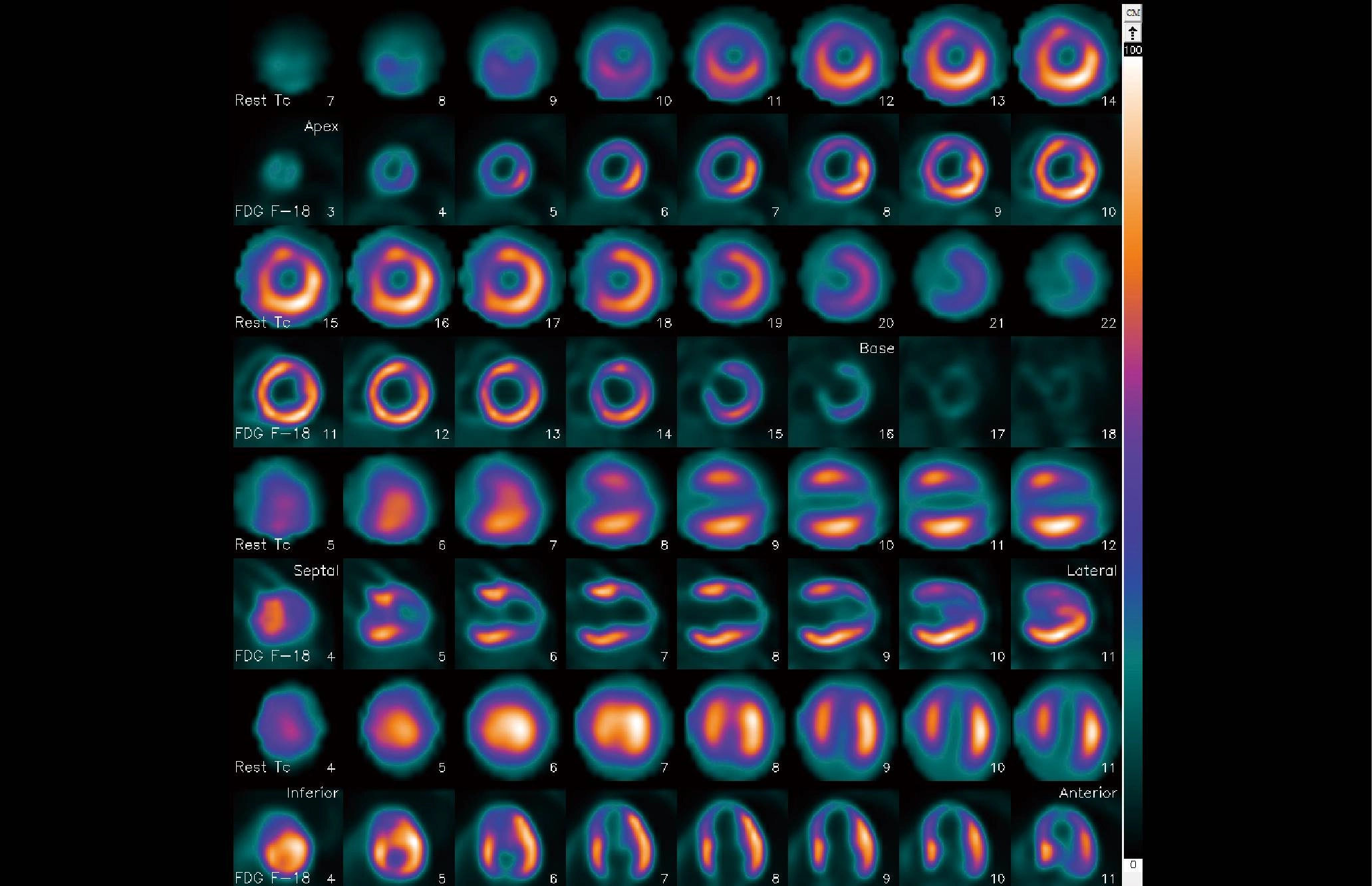 uMI 780 | Ultra-Fast High-Resolution Digital PET/CT
