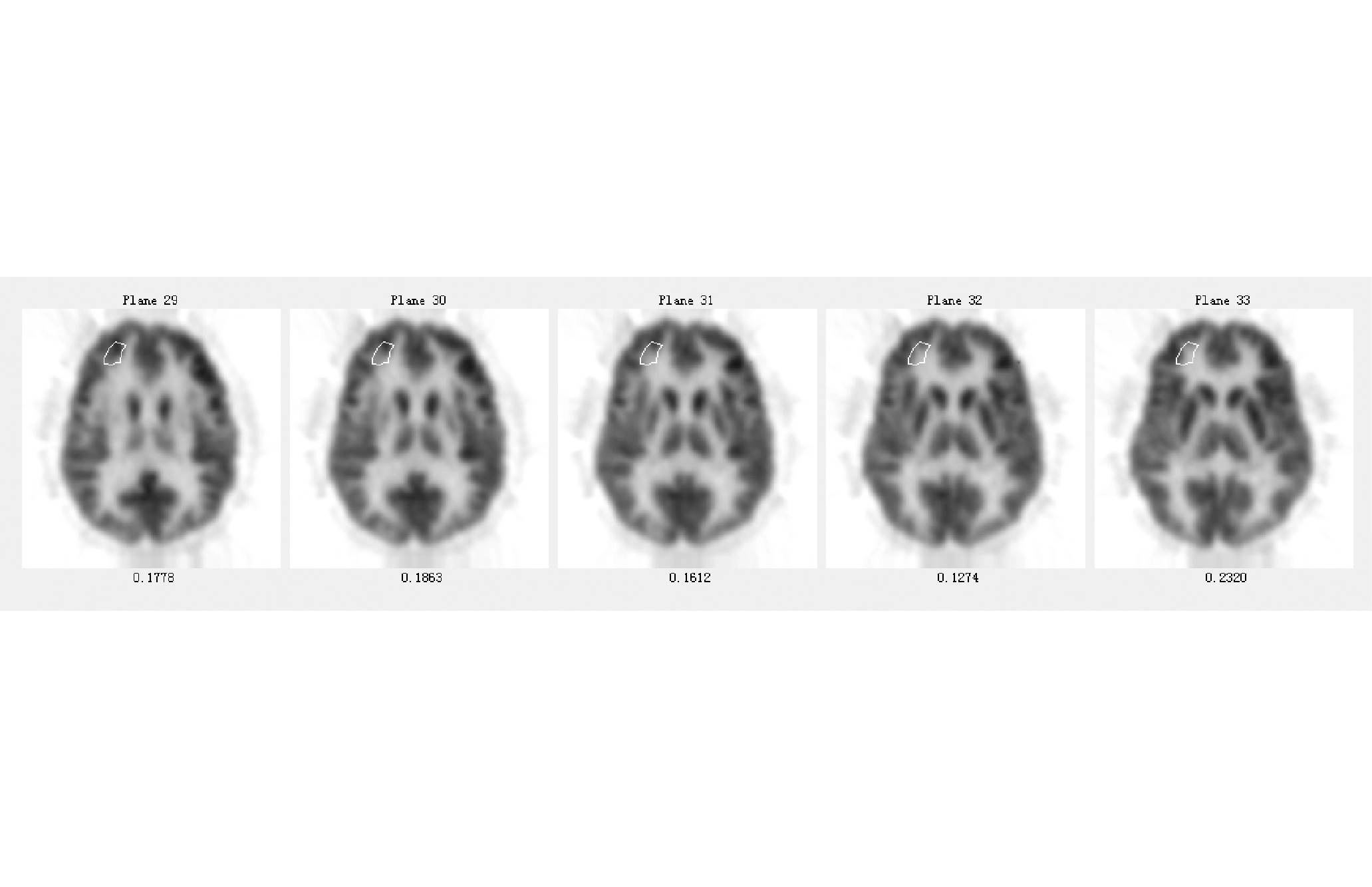 uMI 780 | Ultra-Fast High-Resolution Digital PET/CT