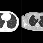 uMI 780 | Ultra-Fast High-Resolution Digital PET/CT