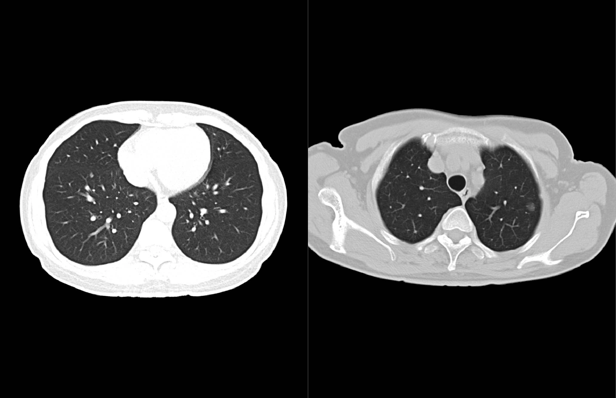 uMI 780 | Ultra-Fast High-Resolution Digital PET/CT