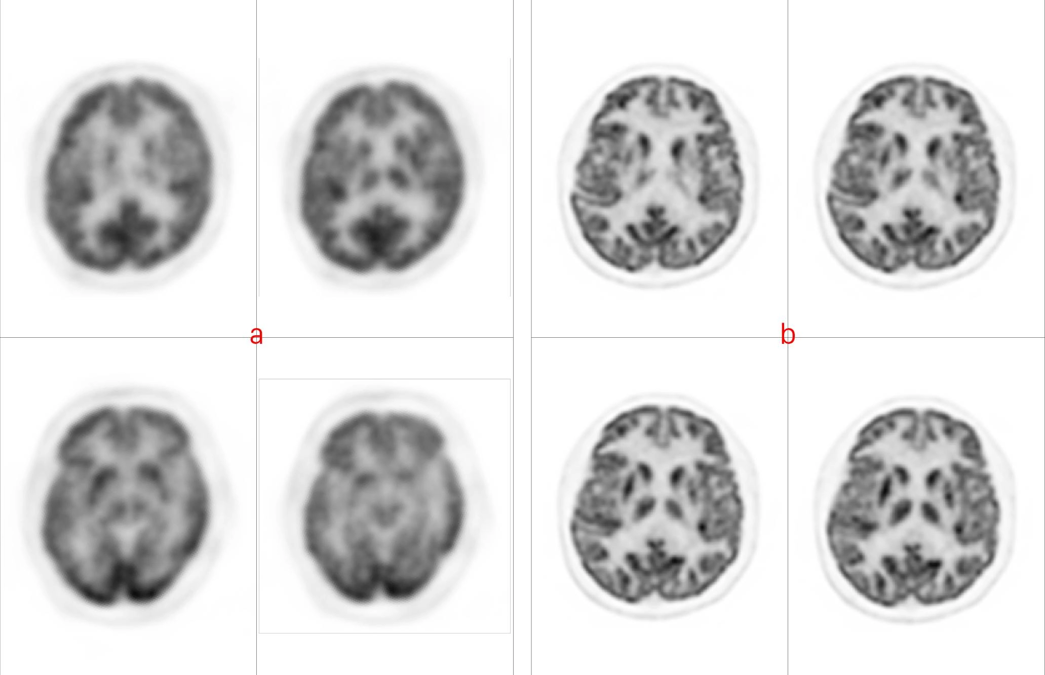 uMI 780 | Ultra-Fast High-Resolution Digital PET/CT