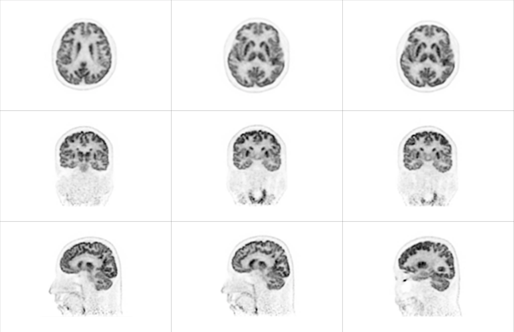 uMI 780 | Ultra-Fast High-Resolution Digital PET/CT