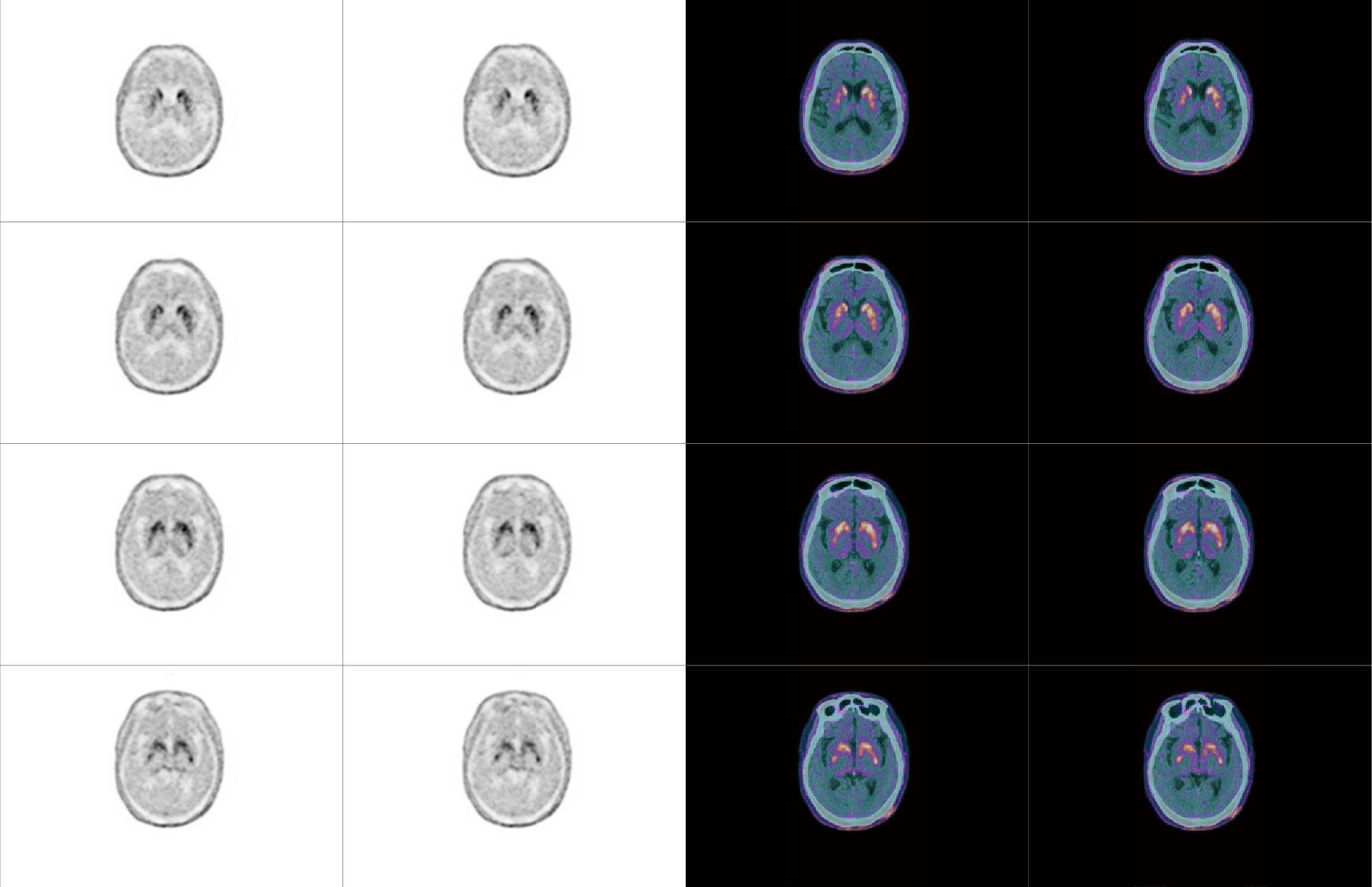 uMI 780 | Ultra-Fast High-Resolution Digital PET/CT