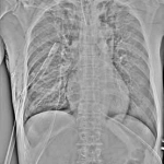 AeroDR 3, Wireless Digital Radiography System