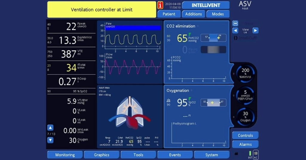 Eπιλογή των σωστών ρυθμίσεων αερισμού για τη θεραπεία ασθενών με covid
