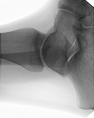 Φορητό Ακτινοσκοπικό Μηχάνημα C-arm, ORTHOSCAN MOBILE DI