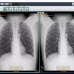 AERODR NS™, Φορητός Ψηφιακός Ανιχνευτής