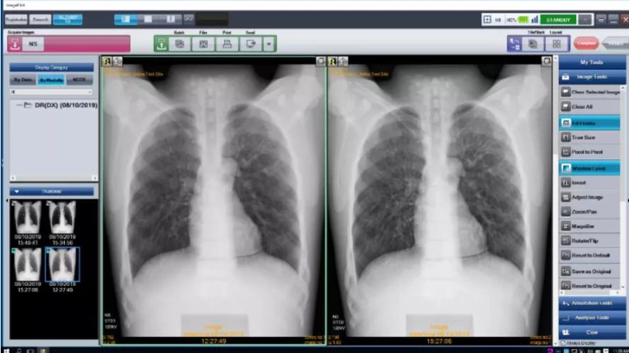 AERODR NS™, Φορητός Ψηφιακός Ανιχνευτής