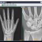 AERODR NS™, Φορητός Ψηφιακός Ανιχνευτής