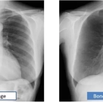 AERODR NS™, Φορητός Ψηφιακός Ανιχνευτής