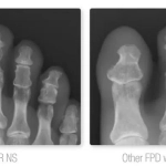 AERODR NS™, Φορητός Ψηφιακός Ανιχνευτής