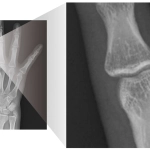 AeroDR 3 HD2, Wireless Digital Radiography System