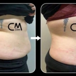 CmSlim, τεχνολογία υψηλής έντασης ηλεκτρομαγνητικής εκγύμνασης μυών