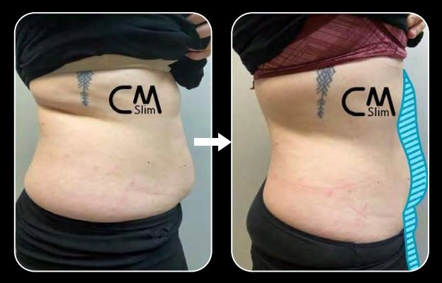 CmSlim, τεχνολογία υψηλής έντασης ηλεκτρομαγνητικής εκγύμνασης μυών