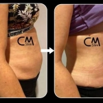 CmSlim, τεχνολογία υψηλής έντασης ηλεκτρομαγνητικής εκγύμνασης μυών