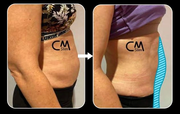 CmSlim, τεχνολογία υψηλής έντασης ηλεκτρομαγνητικής εκγύμνασης μυών